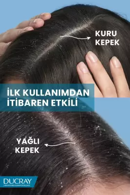 Ducray Kelual Squanorm Kepek Önleyici ve Kaşıntı Hissini Yatıştırıcı Losyon 200 ml - 3